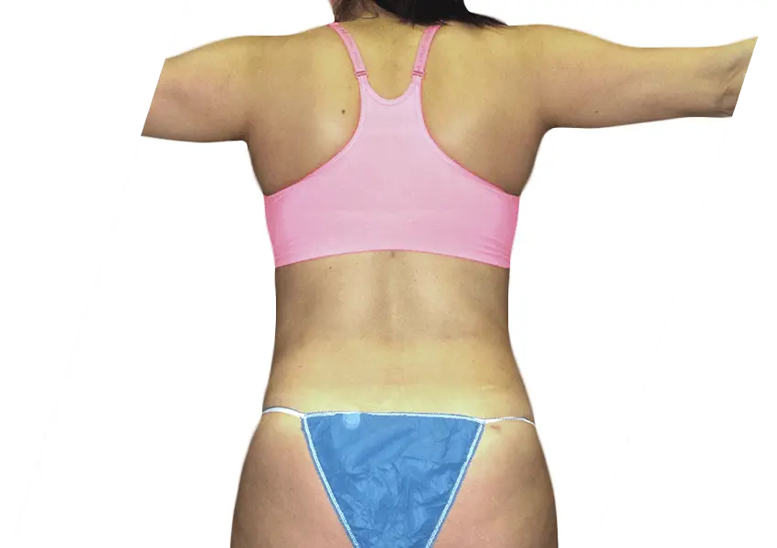 Liposuction Houston